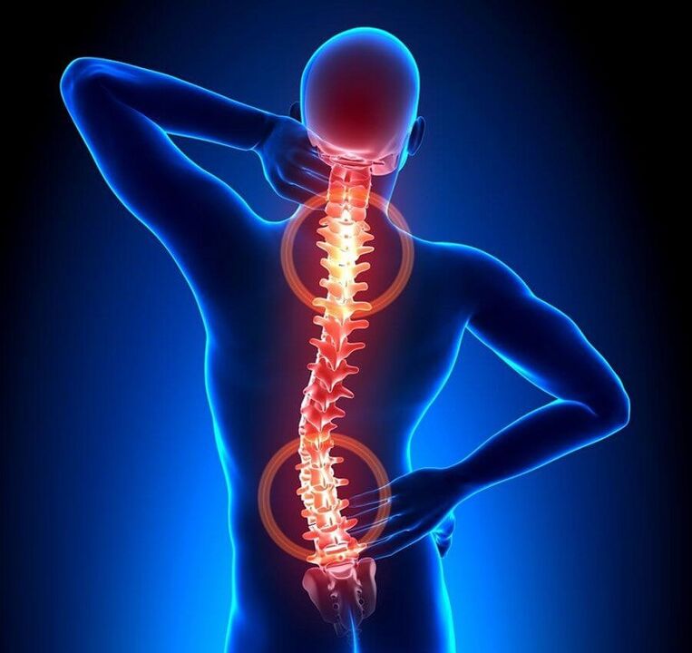 osteocondrosis de la columna vertebral como causa de dolor de espalda
