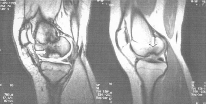 radiografía de osteocondrosis disecante en la articulación de la rodilla