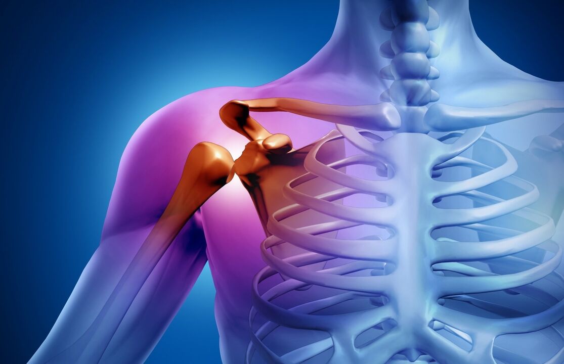 artrosis de hombro