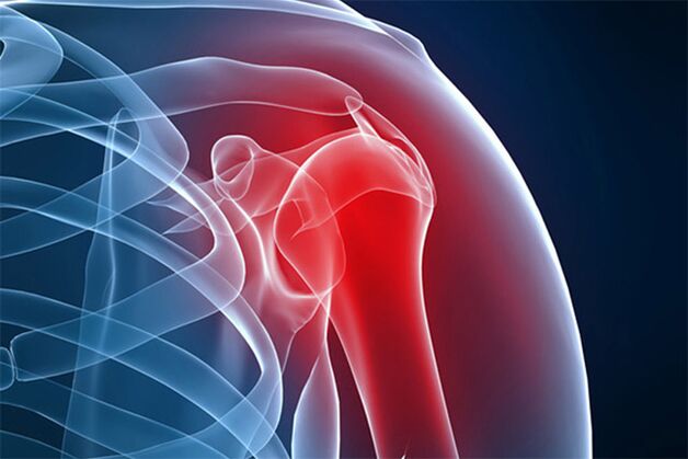 dolor de hombro por artrosis