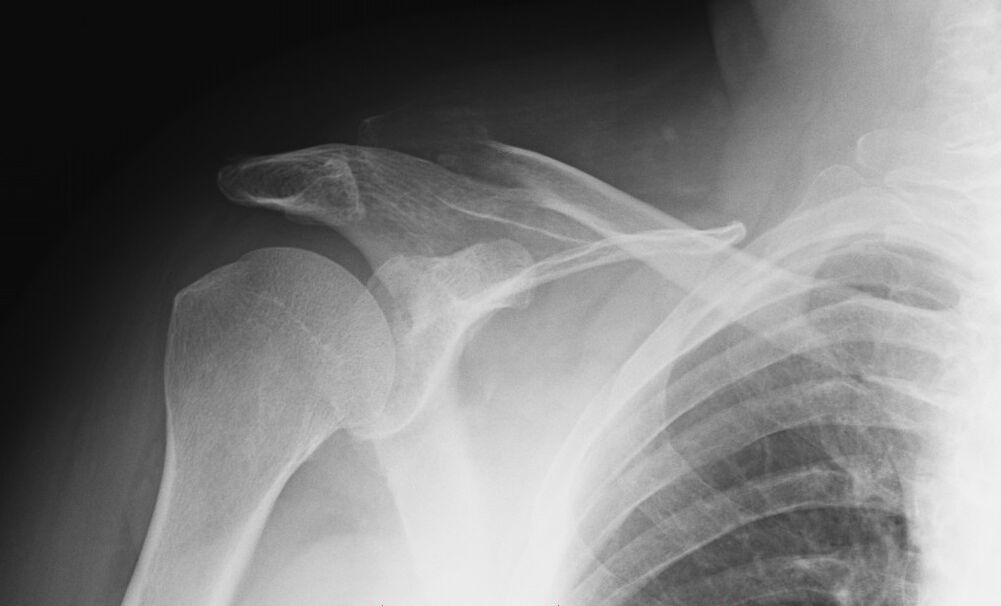 radiografía de artrosis de hombro