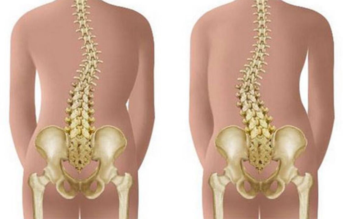 escoliosis como causa de dolor de espalda en la zona de los omoplatos