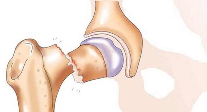 Una fractura del cuello femoral se acompaña de un dolor intenso en la articulación de la cadera. 