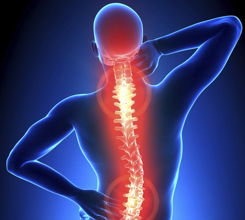 Osteocondrosis de la columna