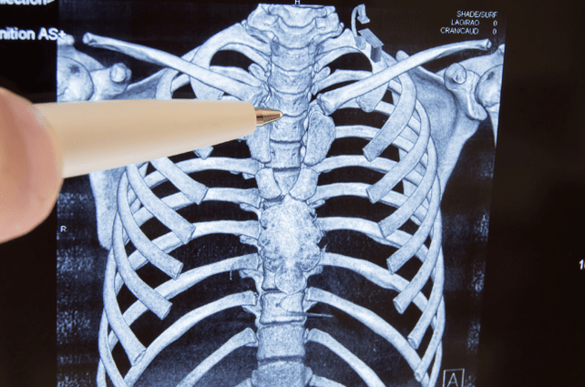 Osteocondrosis