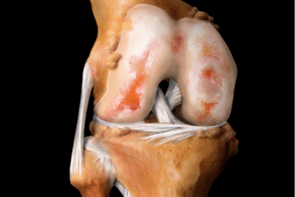Daño a la articulación de la rodilla debido a artrosis.